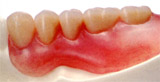 マグネット式義歯
